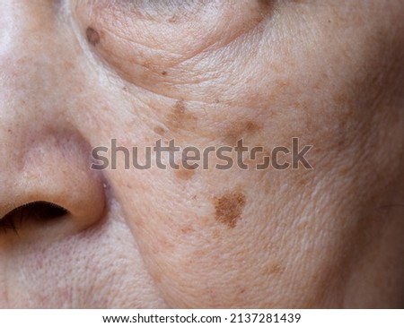 Small brown patches called age spots on face of Asian elder woman. They are also called liver spots, senile lentigo, or sun spots. Closeup view. Royalty-Free Stock Photo #2137281439