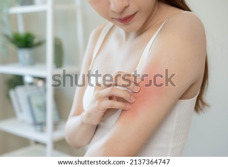 Dermatology, asian young woman, girl allergy, allergic reaction from atopic, insect bites on her arm, hand in scratching itchy, itch red spot or rash of skin. Healthcare, treatment of beauty. Royalty-Free Stock Photo #2137364747