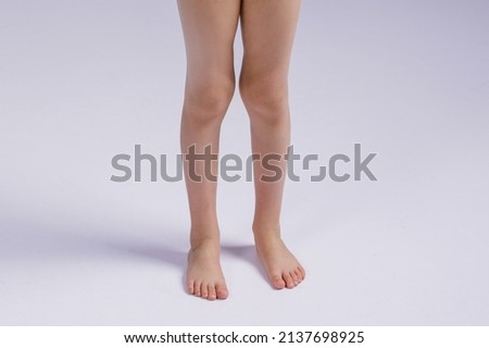 the problem of knee deformity in a child. Legs of a girl close-up with a problem Royalty-Free Stock Photo #2137698925