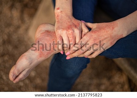eczema dermatitis on hands and feet. red spots on the skin. dry skin. Royalty-Free Stock Photo #2137795823
