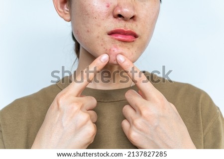 Cropped shot of woman pointing to acne occur on her lower face. Inflamed acne consists of swelling, redness, and pores that are deeply clogged with bacteria, oil, and dead skin cells. Royalty-Free Stock Photo #2137827285