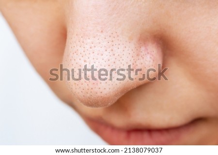 Close-up of a woman's nose with black heads or black dots isolated on a white background. Acne problem, comedones. Enlarged pores on a face. Cosmetology dermatology concept. Blackheads on greasy skin Royalty-Free Stock Photo #2138079037