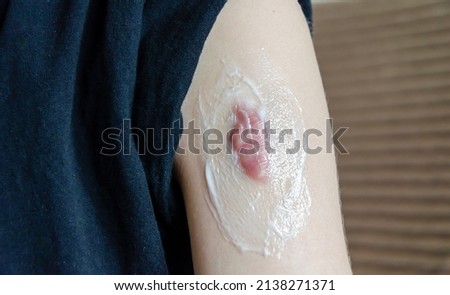 Applying cream to remove the scar. Close-up of a keloid scar on the shoulder of a young woman. Removal of formations on the skin. Royalty-Free Stock Photo #2138271371