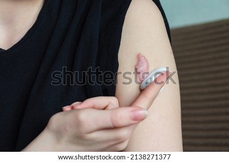 Applying cream to remove the scar. Close-up of a keloid scar on the shoulder of a young woman. Removal of formations on the skin. Royalty-Free Stock Photo #2138271377