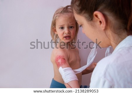 Child burn injury, burns treatment and healing, pediatrician is dressing wound on toddler arm with a sterile non-adhesive bandage Royalty-Free Stock Photo #2138289053