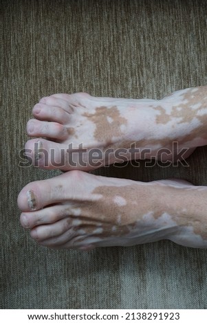 a pair of feet with psoriasis