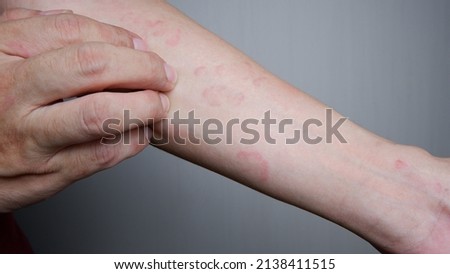 Close up image of arm suffering severe urticaria or hives or kaligata. scratching itchy hands. Allergy symptoms. Royalty-Free Stock Photo #2138411515