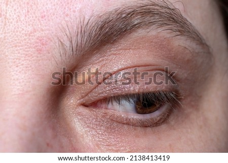 Xanthelasma,  elevated yellowish growth on the eyelids, macro shot Royalty-Free Stock Photo #2138413419