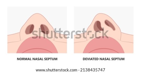 NASAL-SEPTUM Stock Vector Images - Avopix.com