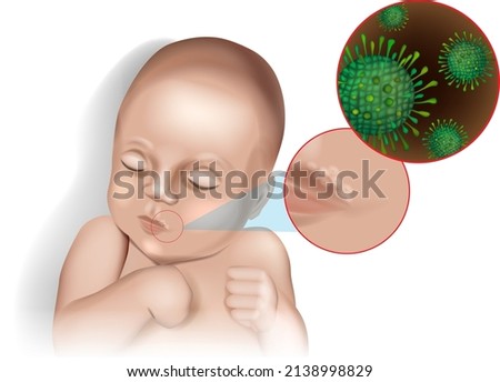 Vector illustration of the herpes virus on the lip of a child.Acute herpetic stomatitis in children. Infectious viral disease Herpes simplex virus. VZV Royalty-Free Stock Photo #2138998829