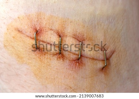 Surgical staples for sutures to close skin. First aid for a deep cut on the skin. Antiseptic and scar treatment. Royalty-Free Stock Photo #2139007683