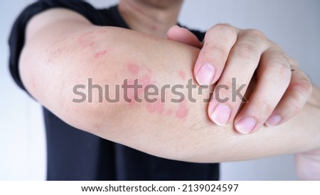Close up image of arm suffering severe urticaria or hives or kaligata. scratching itchy hands. Allergy symptoms. Royalty-Free Stock Photo #2139024597