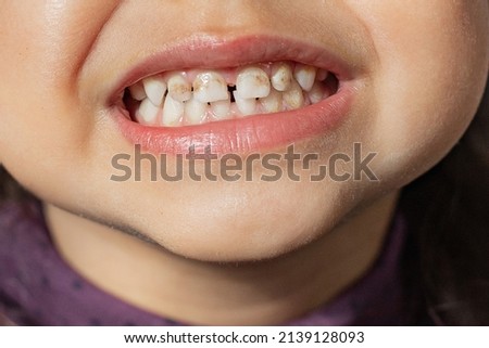 The child shows teeth with hypoplasia. Pediatric dentistry and periodontology, bite correction. Health and dental care, caries treatment, baby teeth. Dark spots on teeth Royalty-Free Stock Photo #2139128093