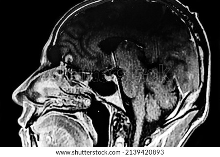CAT SCAN with brain toxoplasmosis. Multiples brain tumors with ring enhancing lesion and perilesional edema. Located in mesencephalon and thalamus white matter, cortical and subcortical area. Royalty-Free Stock Photo #2139420893