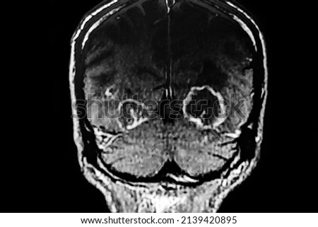 CAT SCAN with brain toxoplasmosis. Multiples brain tumors with ring enhancing lesion and perilesional edema. Located in mesencephalon and thalamus white matter, cortical and subcortical area. Royalty-Free Stock Photo #2139420895