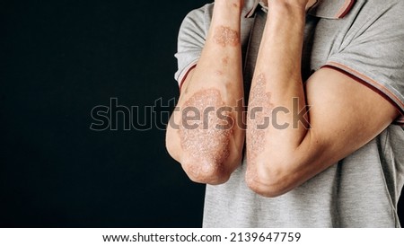 Acute psoriasis on the elbows is an autoimmune incurable dermatological skin disease. A large red, inflamed, flaky rash on the elbows. Joints affected by psoriatic arthritis. Royalty-Free Stock Photo #2139647759