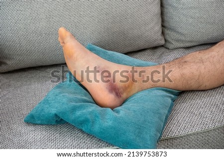 Ankle injury with dislocation and sprains. Fracture or Leg sprain injury of young sports man.  Royalty-Free Stock Photo #2139753873