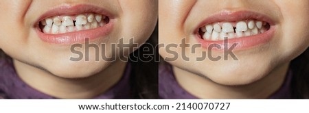 The child shows milk teeth with stains and plaque close-up. Two photos before and after. Children's dentistry. Health and dental care, caries treatment, baby teeth. Dark spots on teeth Royalty-Free Stock Photo #2140070727