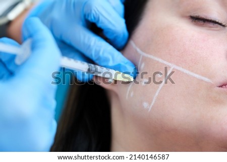 facial marking with white dermoplastic pencil of points for mandibular anti-bruxism treatment with botulinum toxin Royalty-Free Stock Photo #2140146587