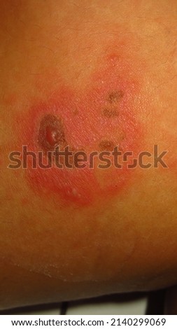 blurry and grainy picture of skin disease herpes zoster red inflamed skin lumps filled with water in a brown skin