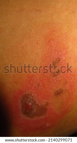 blurry and grainy picture of skin disease herpes zoster red inflamed skin lumps filled with water in a brown skin WOUND