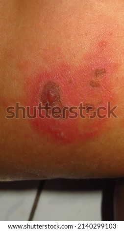 blurry and grainy picture of skin disease herpes zoster red inflamed skin lumps filled with water in a brown skin