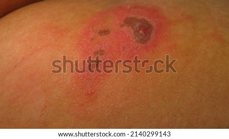 blurry and grainy picture of skin disease herpes zoster red inflamed skin lumps filled with water in a brown skin WOUND