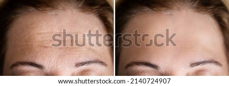 Age Anti Forehead Wrinkles Treatment Before And After Royalty-Free Stock Photo #2140724907