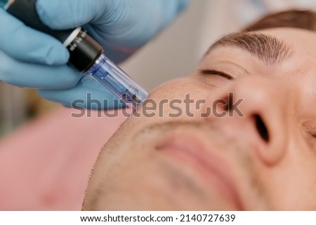 Collagen Induction Therapy Microneedling For the face of a European man close-up Royalty-Free Stock Photo #2140727639
