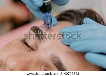 Procedure of induction therapy with microneedles and collagen on the face of a European man close-up Royalty-Free Stock Photo #2140727643
