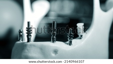 Titanium abutments in the artificial jawbone close-up. Royalty-Free Stock Photo #2140966107