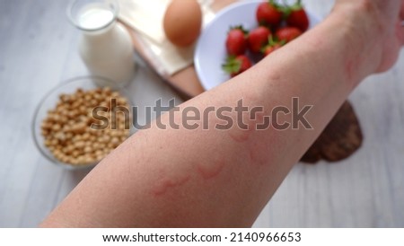Close up image of arm suffering severe urticaria or hives or kaligata with ilustration of allergy trigger foods.  Eggs, milk, beans, strawberry, and chesse. Royalty-Free Stock Photo #2140966653