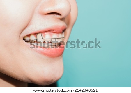 Close up white teeth of young Asian beautiful woman smiling wear silicone orthodontic retainers on teeth isolated on blue background, retaining tools after removable braces. Dental hygiene health Royalty-Free Stock Photo #2142348621