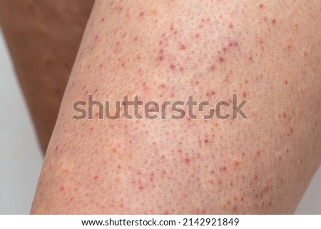 Legskin macro of a young woman suffering from pillar keratosis, frequent cause of atopic dermatitis and sketchy Royalty-Free Stock Photo #2142921849