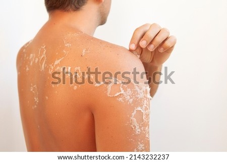 Peeling skin at man back and shoulder from sunburn, flaking skin and skincare concept Royalty-Free Stock Photo #2143232237