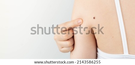 Young woman pointing at dark brown moles on her back for self-exams skin. Being aware of changes in your moles to detecting skin cancer, especially malignant melanoma. Skin disease concept. Royalty-Free Stock Photo #2143586255
