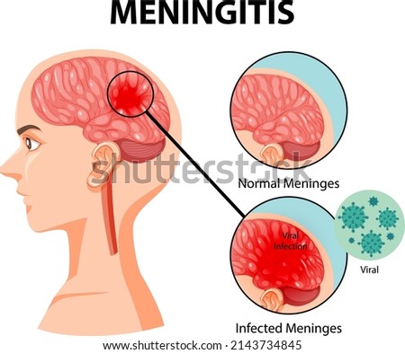 Diagram showing meningitis in human brain illustration
