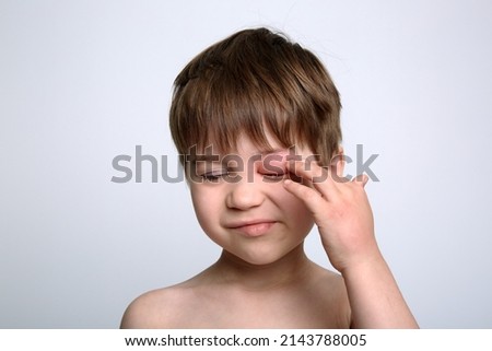 Child with red swollen eye from insect bite. Quincke edema. Portrait of unhappy caucasian appearance boy. Isolated background. Face of allergic person. Copy space. Studio. Allergy. Sick body part. Royalty-Free Stock Photo #2143788005
