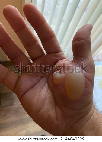 2nd degree burn. Happened when I placed my hand on a standup heater. Royalty-Free Stock Photo #2144040529
