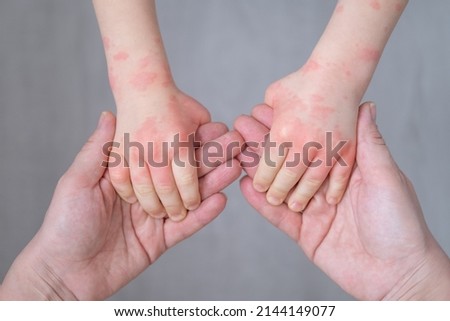 close up mother holding kids hands with allergic rash or eczema. severe allergic reaction, atopic skin Royalty-Free Stock Photo #2144149077