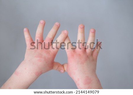 close up kids hand with allergic rash or eczema. severe allergic reaction, atopic skin Royalty-Free Stock Photo #2144149079