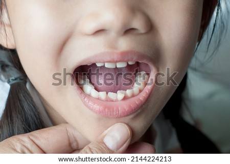 Permanent teeth that are coming up in place of milk teeth. Royalty-Free Stock Photo #2144224213