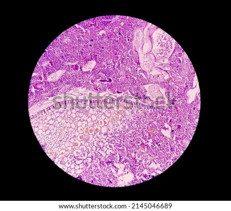 Microscopic image (photomicrograph) of a cross section of an appendix showing acute appendicitis.