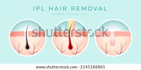 IPL Laser hair removal verctor illustration concept Royalty-Free Stock Photo #2145186865