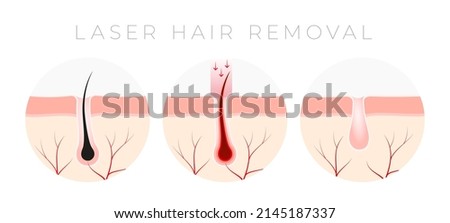 IPL Laser hair removal verctor illustration concept Royalty-Free Stock Photo #2145187337