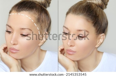 Alopecia Areata,female pattern baldness,Treatment for hair loss,Hair transplant,Surgery to implant artificial hairs Royalty-Free Stock Photo #2145353545