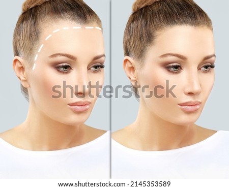 Alopecia Areata,female pattern baldness,Treatment for hair loss,Hair transplant,Surgery to implant artificial hairs Royalty-Free Stock Photo #2145353589