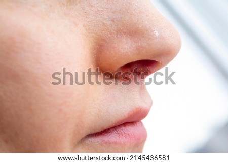 Herpes on the nose - Pretty young caucasian woman with herpes her on nose, close-up. Human Virus Royalty-Free Stock Photo #2145436581
