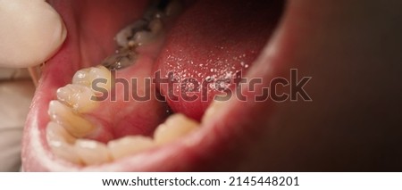 Decayed tooth root canal treatment. Tooth or teeth decay of lower molar. Restoration with a composite filling. Adult caries. bad teeth. Dental temporary restorative material. Dental concept. close up. Royalty-Free Stock Photo #2145448201