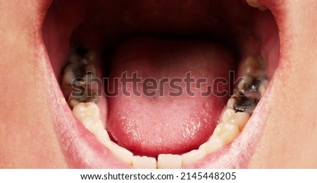 Decayed tooth root canal treatment. Tooth or teeth decay of lower molar. Restoration with a composite filling. Adult caries. bad teeth. Dental temporary restorative material. Dental concept. close up. Royalty-Free Stock Photo #2145448205